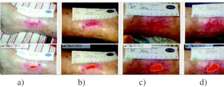 Figure 3. Telap smartphone application, top: consecutive pictures , bottom: wound contour measurement