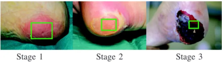 Figure 7. Stages of heel bedsore used for the texture synthesize