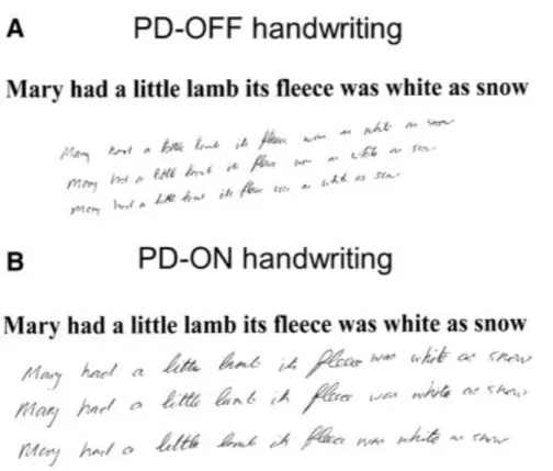 Figure 3 Example of micrographia. A – Handwriting during the “off” period (without  L-dopa)