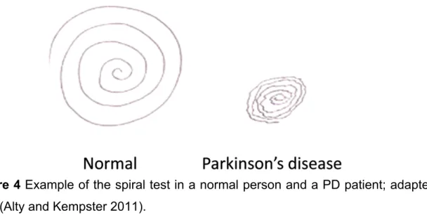 Figure 4 Example of the spiral test in a normal person and a PD patient; adapted  from (Alty and Kempster 2011)