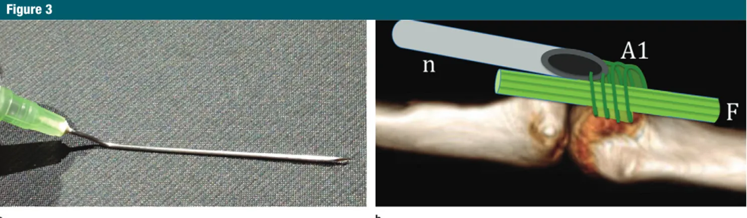 Figure 2:  Anesthesia performed over the release trajectory of the pulley by using the gel pad technique