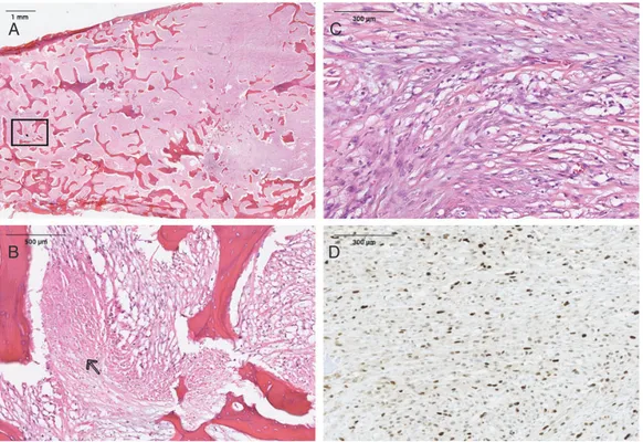 Figure 1. (A) Histological appearance of an intramedullary (central) dedifferentiated osteosarcoma (H&amp;E)