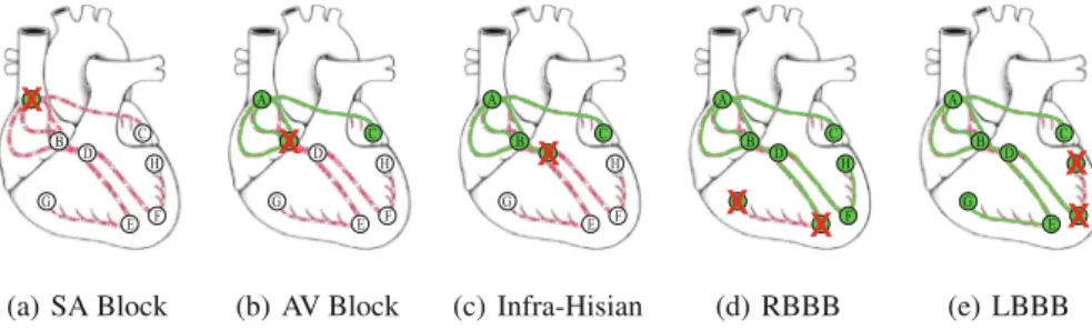 Fig. 3. Impairments in impulse propagation due to the heart blocks [16]