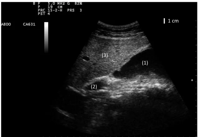 Figure 25 : échographie du foie, coupe transversale, 10 e  espace intercostal ; 1 = vésicule biliaire ; 2 = canal cholédoque,  dilaté ; 3 = foie  (1)  1 cm  1 cm (2) (2) (1) (3) 