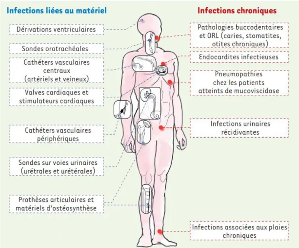 Figure 3. Infections causées et entretenues par des biofilms. Figure tirée de Lebeaux et al