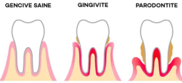 Figure 4. Évolution des maladies parodontales liées au tartre.  Source: Dentego (2017) 