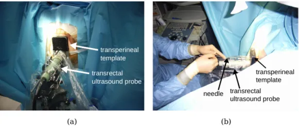Figure 0.5 – Treatment setups for prostate brachytherapy in the OR, images from [10].