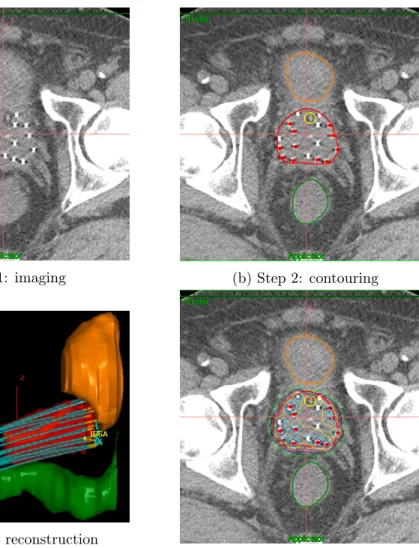 Figure 0.6 – Workflow of treatment planning in HDR prostate brachytherapy: (1) CT image import, (2) Contouring of organs, (3) 3D reconstruction of organs and catheters, and (4) Treatment planning and plan evaluation.