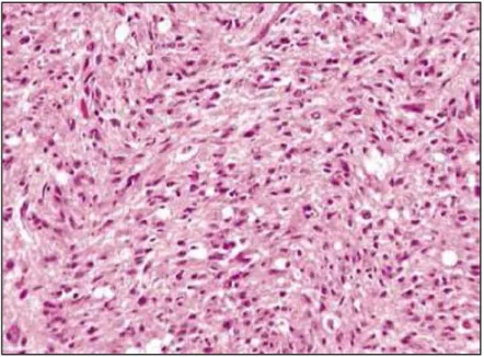 Figure  8  Coupe  histologique  d’un  astrocytome  fibrillaire  chez  un  chien 