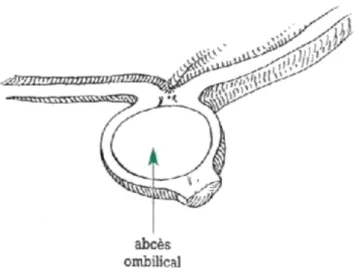 Figure 2 : Abcès extra-abdominal (omphalite simple) [7] 