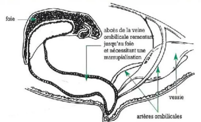 Figure 4 : Abcès de la veine ombilicale [7] 