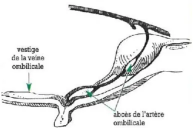 Figure 5 : Omphaloartérite [7] 