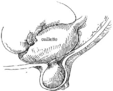 Figure 6 : Hernie simple [8] 
