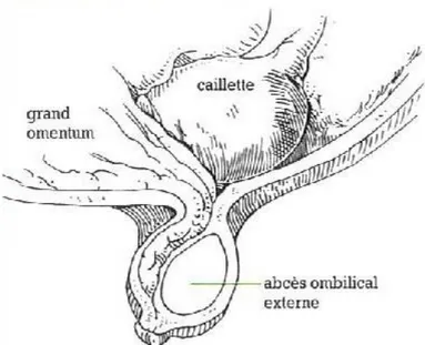 Figure 7 : Hernie compliquée d'un abcès ombilical [8] 