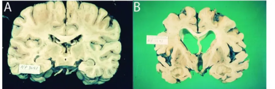 Figure  2  :  Image  de  l’atrophie  cérébrale  et  de  la  dilatation  des  ventricules cérébraux