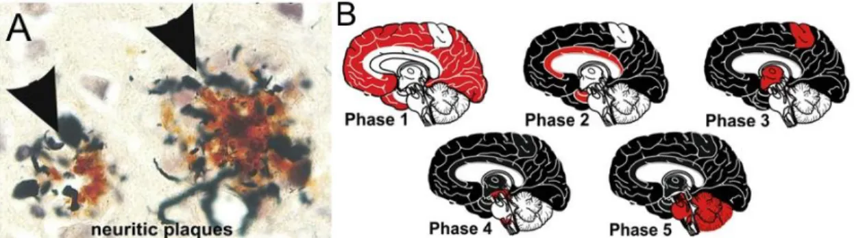 Figure 4 : Image des plaques neuritiques (A) et schéma de l’évolution spatio-temporelle de la pathologie  amyloïde (B)