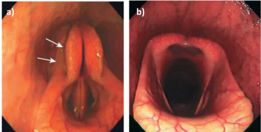 Figure 26 : Images endoscopiques de larynx : a) en adduction totale, b) en abduction totale (d’après Barakzai, 2006) 