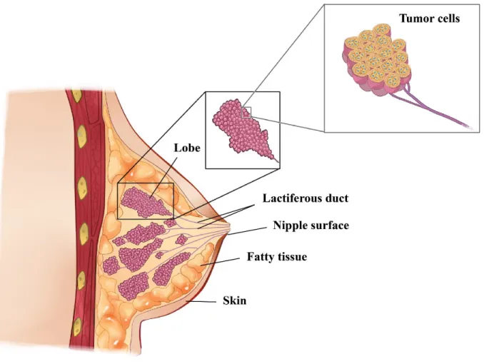 Figure 1.2. Schematic female breast anatomy  and lobular carcinoma adapted from Terese  Winslow image (National Cancer Institute) [17]