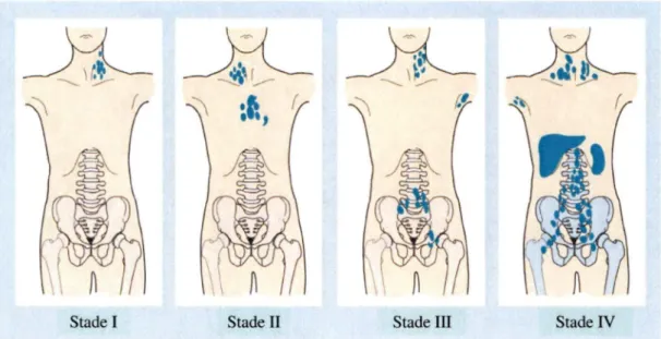 Figure 2 : Stades du lymphome de Hodgkin 