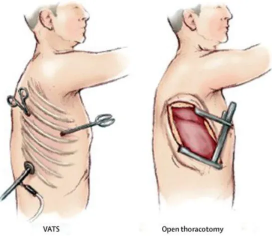 Figure 7: Chirurgie par thoracoscopie vidéo-assistée (VATS) en comparaison avec la thoracotomie (Open  thoracotomy)