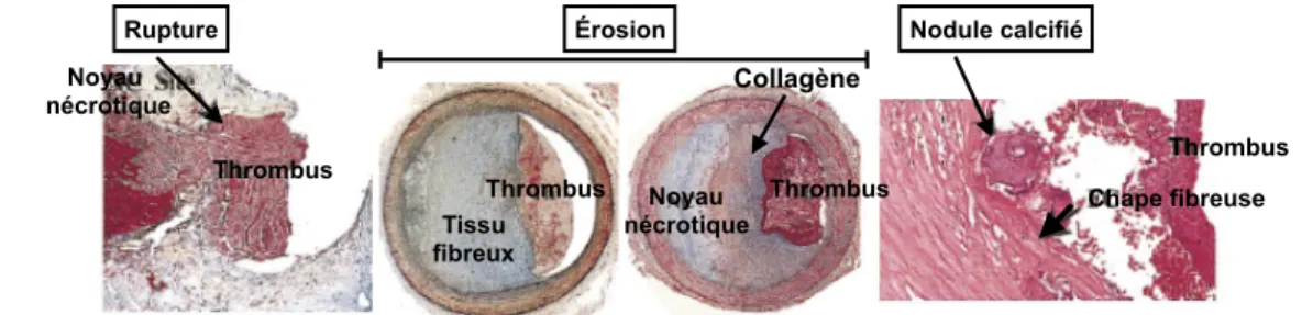 Figure 6. Déstabilisation de la plaque d’athérosclérose.  Figure adaptée de Virmani et coll