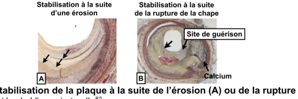 Figure 7. Stabilisation de la plaque à la suite de l’érosion (A) ou de la rupture (B)