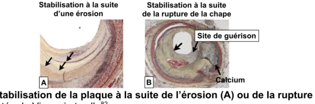 Figure 7. Stabilisation de la plaque à la suite de l’érosion (A) ou de la rupture (B)