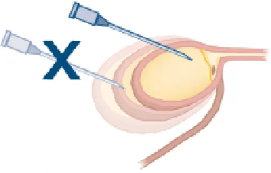 Figure  2 :  Fuite  d’urine  dans  la  cavité  abdominale  lors  d’une  cystocentèse  réalisée  en  position  ventro- ventro-dorsale avec une pression trop importante exercée sur la vessie (S : peau au niveau abdominal ; B : paroi  de la vessie), (Kruger e