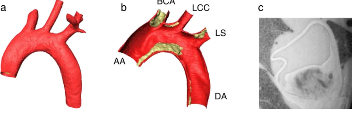 Fig. 1. (a) Reconstructed mouse aortic arch. (b) Half of the mouse aortic arch revealing the atherosclerotic plaque (yellow) on the vessel wall