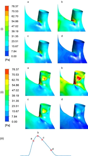 Fig. 9. WSS distribution on the brachiocephalic artery at four stages during the cardiac cycle as indicated on the volumetric ﬂow rate diagram (iii); (a) systolic acceleration, (b) peak systole and (c &amp; d) systolic deceleration