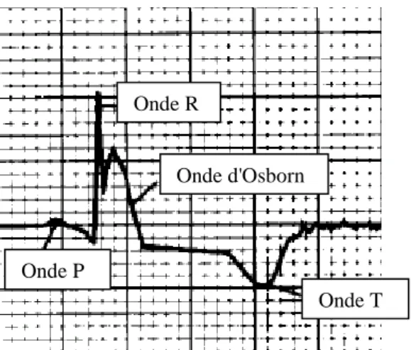 Figure 5 : Visualisation de l'onde d'Osborn sur un électrocardiogramme (d'après HURST) 26