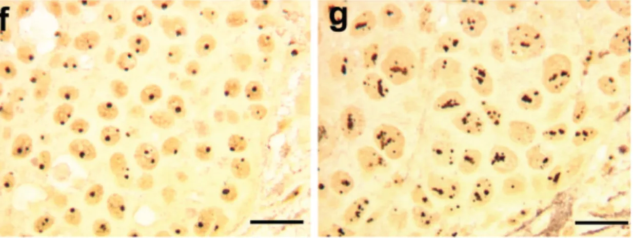 Figure 1-1 : Section histologique de cancer du sein chez deux patientes. Coloration  à l'argent, permet d'observer les AgNOR (Argent Nucleolar Organiser Regions)