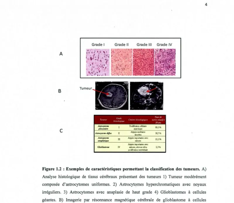 Figure  1.2  : Exemples  de  caractéristiques  permettant  la  classification  des  tumeurs