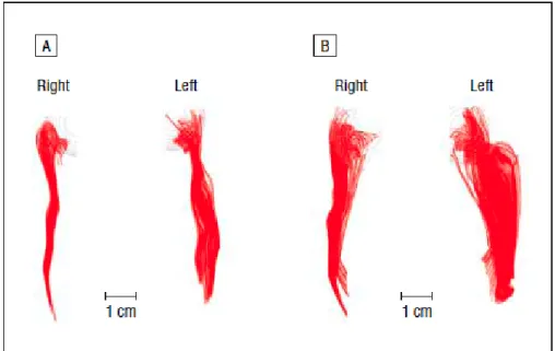 Fig. 4 : Illustration de l’augmentation de volume des voies de conduction  chez les personnes présentant des TED (d’après Minshew &amp; al., 2007) Représentation de voies de conduction impliquées dans des tâches cognitives