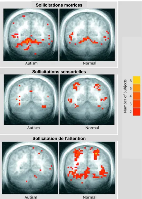 Fig. 12 : Comparaison du schéma d’activation du cervelet entre individus avec et sans  TED lors de l’exécution de tâches évaluant les compétences motrices, sensorielles et  l’attention (d’après A LLEN  &amp; C OURCHESNE , 2003) 