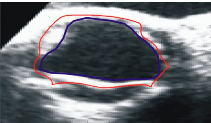 Figure 23 : Exemple d'ajustement par les contours actifs. En rouge le contour initial et en  bleu le contour après la déformation