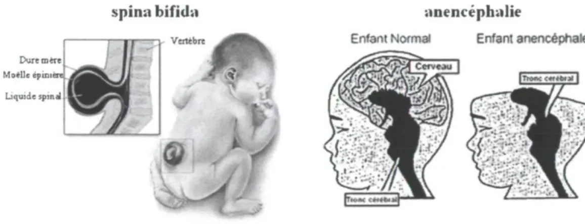 Figure 1.1: Représentations du spina bifida et de l'anencéphalie, adaptés des sites des  centres pour la prévention et le contrôle des maladies (www.cdc.gov/az/a.html) et  d'information sur l'anencéphalie (www.anencephalie-info.org) 