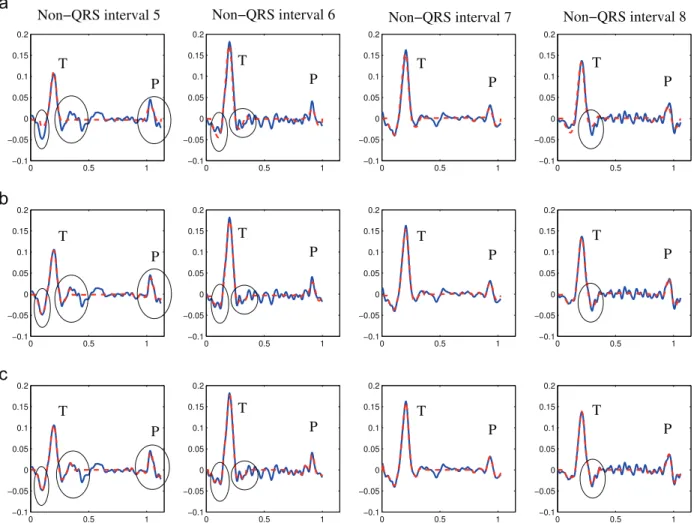 Table 2 shows the results for Se, P þ , and m7 s obtained for the entire QTDB. It can be seen that the two proposed methods detect the P and T waves annotated by the cardiologist with high sensitivity: the sensitivity Se is 100% for the T waves and 99.93% 