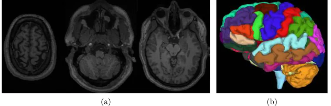 Figure 2.2 – Reconstruction 3D d’un cerveau (b) à partir des images obtenues par IRM (a).