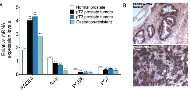 Figure 18 – Surexpression de la proprotéine convertase PACE4 dans le cancer de la prostate 