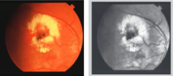 Figure 2 True color digital retina image with circinate exudates  before (left) and after applying CLAHE to its grayscale version  (right).