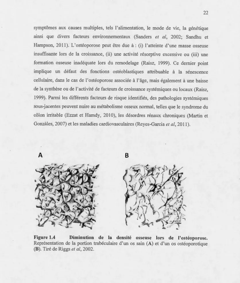 Figure 1.4  Diminution  de  la  densité  osseuse  lors  de  l'ostéoporose. 