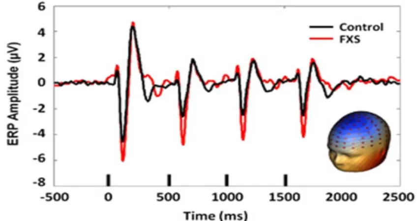 Figure 4. Représentation des courbes N1/P2 chez des sujets contrôles (en noir) et des sujets SXF (en rouge)