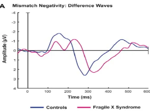 Figure 5. Représentation des courbes MMN chez des sujets contrôles (en bleu) et des sujets SXF (en  rose)