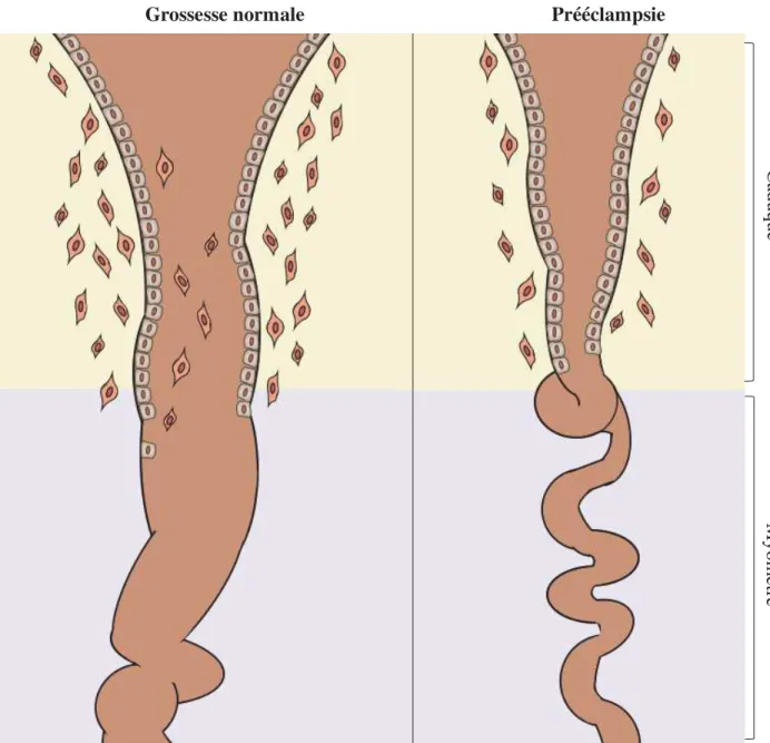 Figure 8: Remodelage des artères spiralées en grossesse normale et en prééclampsie  En grossesse normale, les trophoblastes envahissent les artères spiralées jusqu’au myomètre et  les transforment en vaisseaux sanguins de large diamètre, de grande capacita