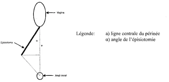 Figure 11:  Mesure de l'angle de !'épisiotomie médiolatérale 