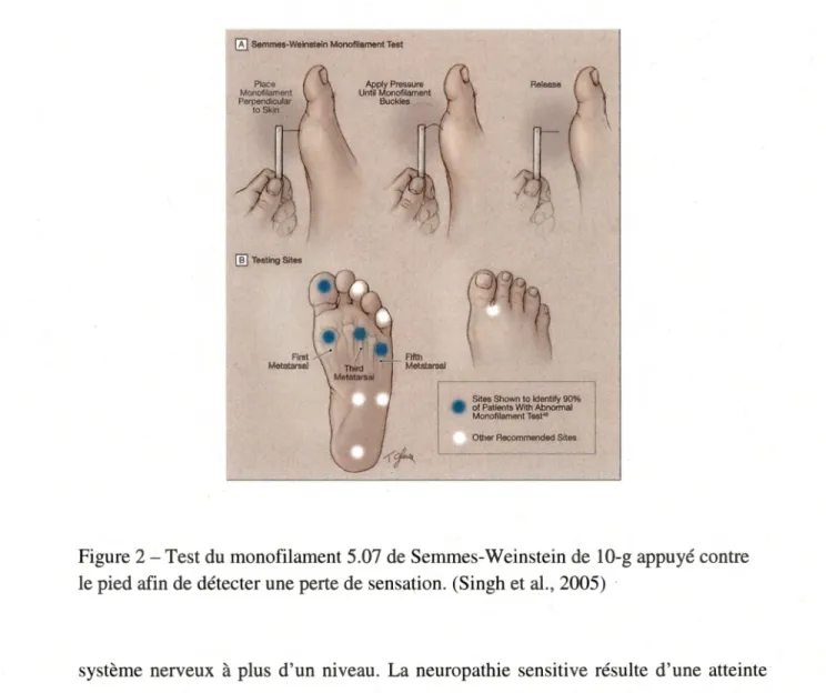 Figure 2-Test du monofilament 5.07 de Semmes-Weinstein de 10-g appuyé contre  le pied afin de détecter une perte de sensation