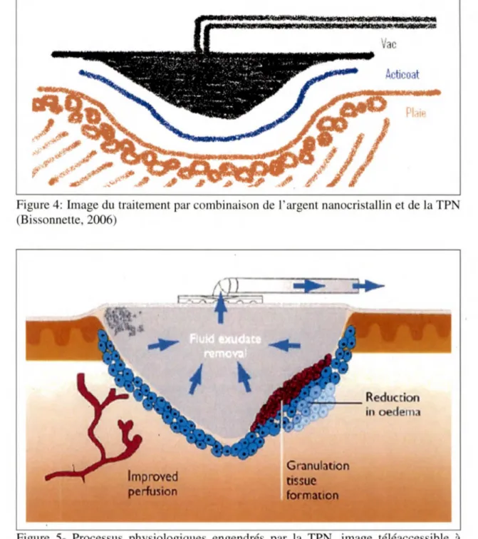 Figure  5- Processus  physiologiques  engendrés  par  la  TPN,  image  téléaccessible  à  l'adresse &lt;http://www.epuap.org/aberdeen/images/horch4.jpg&gt; 