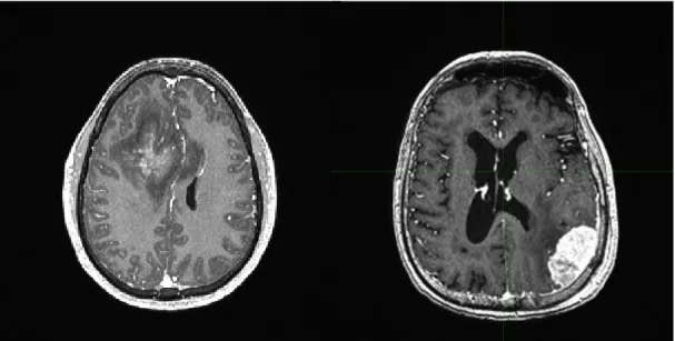 Figure 1 : The difference between intra-axial (left) and extra-axial (right) tumours. 