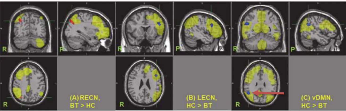 Figure 5 : Altered connectivity in patients with brain tumours 